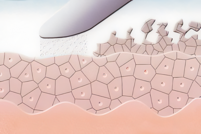Die MDA trägt sanft und sicher die Hornzellen ab
